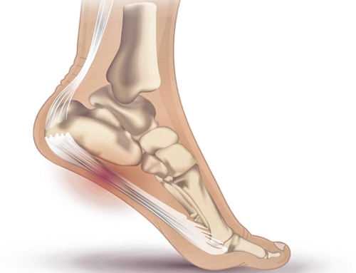 Fascitis plantar